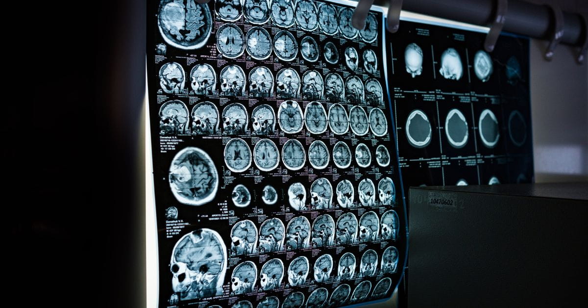 Brain Imaging - North Bengal Neuro Centre Blog